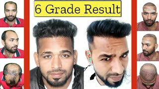 6 Grade Man Gets Amazing Hair Transplant Result Hair Transplant In India