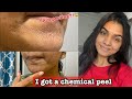 I got a chemical peel for acne scars|| Skin peeling || Experience