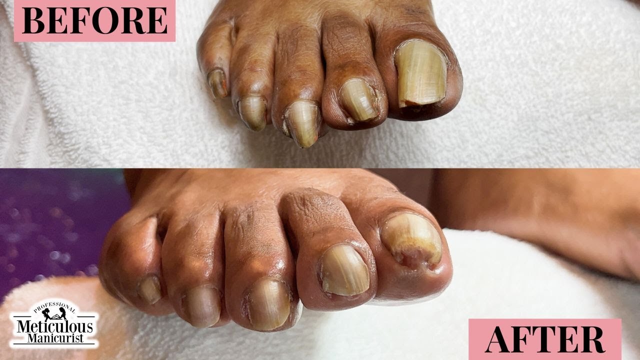 Thick Yellow Toenails Client Pedicure Transformation YouTube