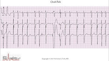 ECG Lesson in Advanced Pacemaker Troubleshooting