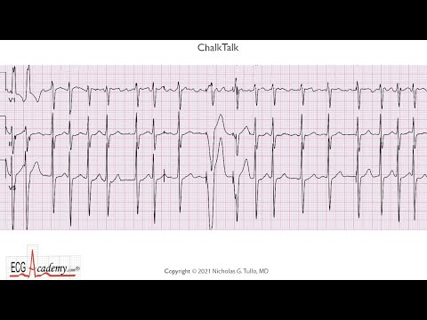 ECG Lesson in Advanced Pacemaker Troubleshooting