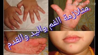 متلازمة اليد والقدم والفم...الفيروس المسبب للطفح الجلدى فى اليد والقدم والفم...اعراضه وعلاجه