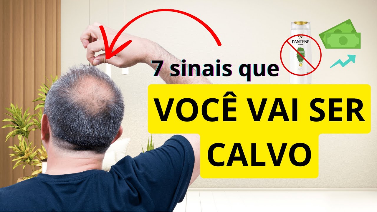 Essas Coisas V o Te Deixar CARECA Como Saber Se Eu Vou Ser CALVO Em 7 essas-coisas-v-o-te-deixar-careca-como-saber-se-eu-vou-ser-calvo-em-7