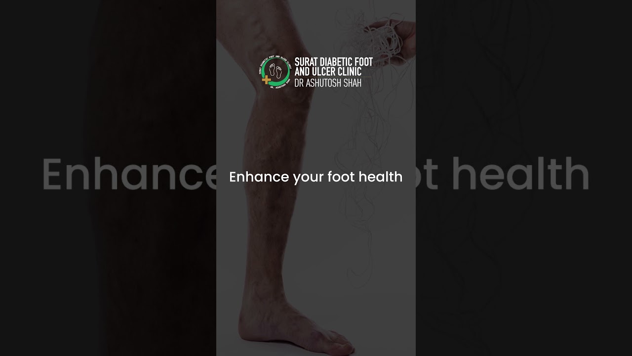 Varicose Vein Treatments at Surat Diabetic Foot and Ulcer Clinic | Dr. Ashutosh Shah