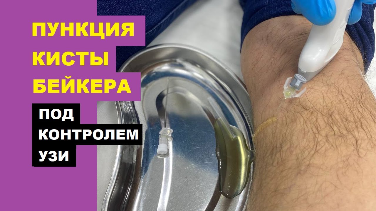 Пункция кисты БЕЙКЕРА под контролем УЗИ - YouTube