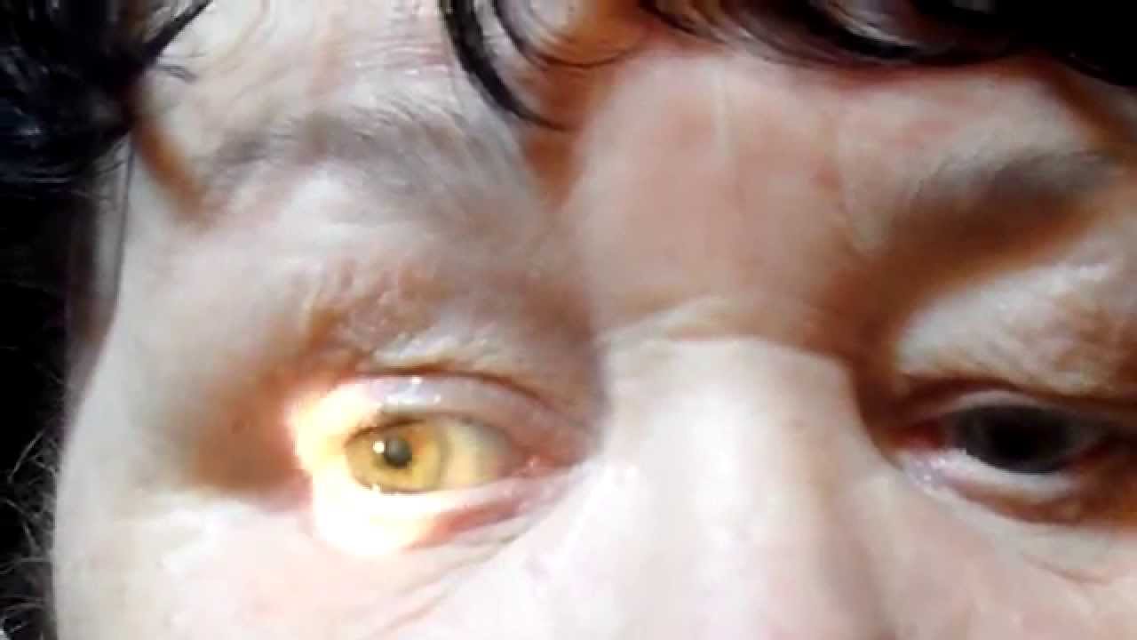 Разрешившаяся передняя ишемическая правосторонняя межъядерная ...