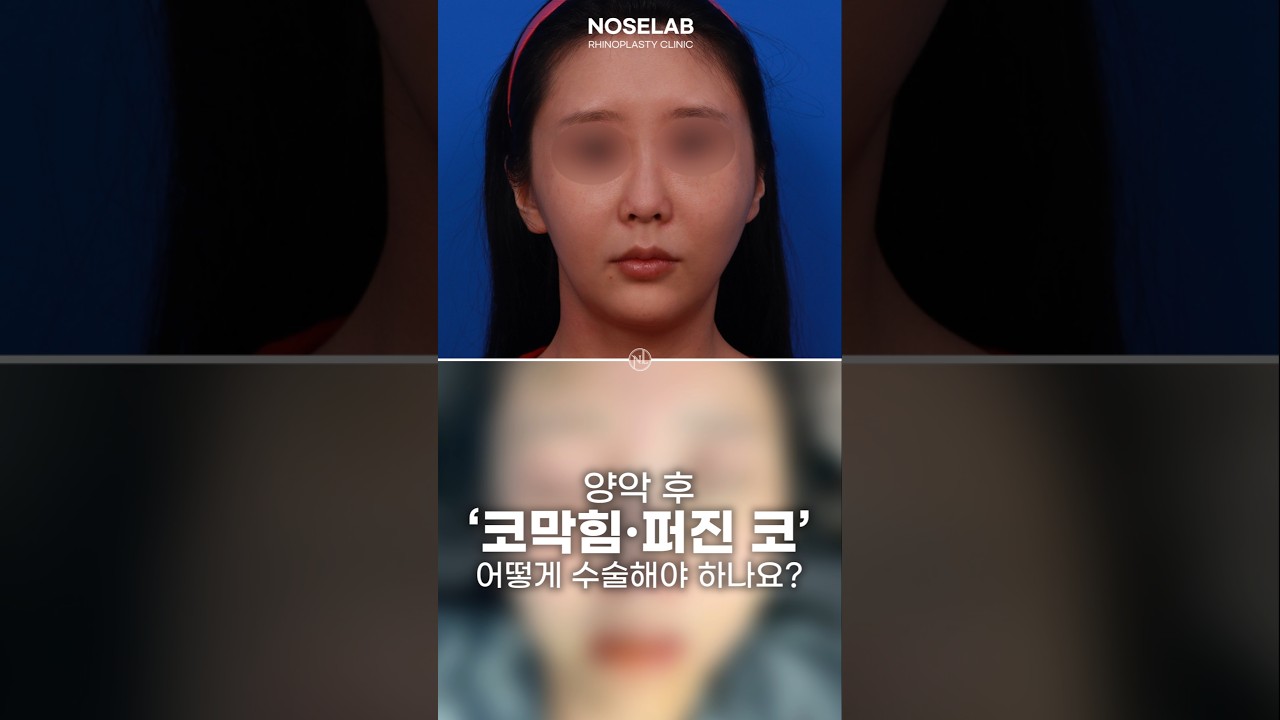 양악 후 코막힘과 퍼진 코 변형, 비중격 손상 교정 사례