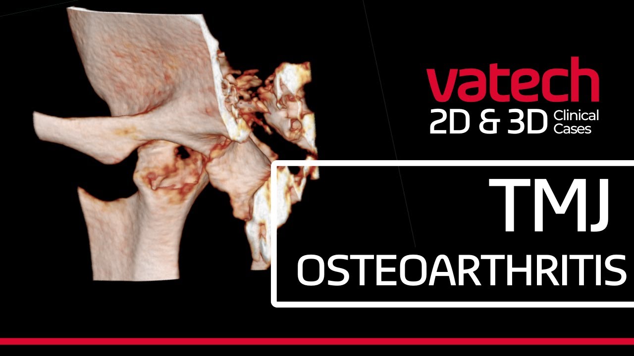 [Vatech 2D & 3D Clinical Cases] 🦷 TMJ Osteoarthritis - YouTube