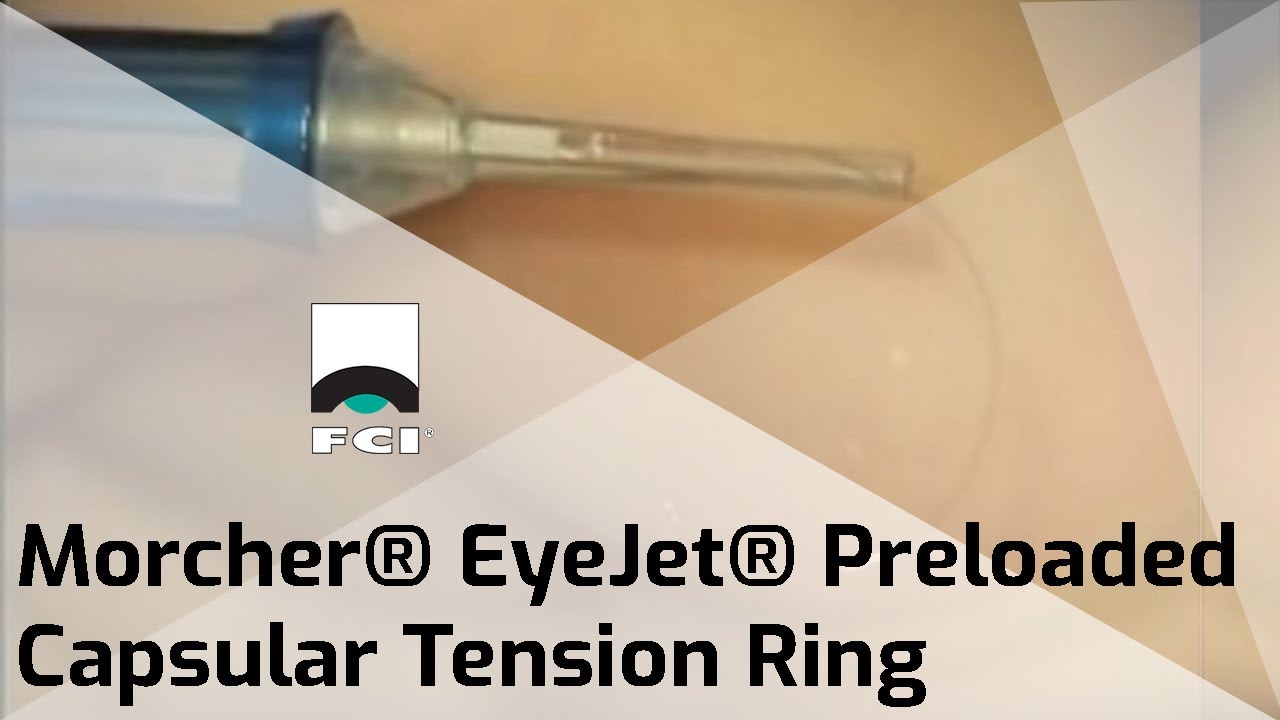 Effect of Capsular Tension Ring Implantation on Postoperative Rotational  Stability of a Toric Intraocular Lens | Journal of Refractive Surgery