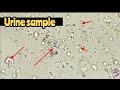 فحص عينة بول مجهريا وكتابة التقرير المناسب urine sample under microscope