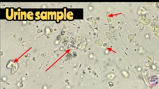 فحص عينة بول مجهريا وكتابة التقرير المناسب urine sample under microscope