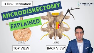 Microdiskectomy: Anatomy, Step by Step Procedure, Risks, Recovery, and Restrictions