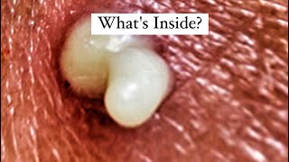What&#39;s inside BLACKHEADS! Pimple Popping Documentary
