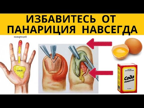 Лечение панариция на пальце ноги в домашних условиях