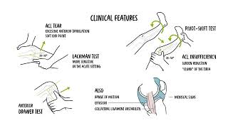 ACL Tear Explained: Causes, Symptoms, Diagnosis and Treatment