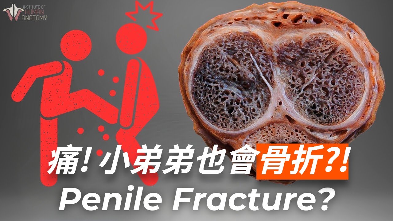 【陰莖骨折】讓人身心受創的一種骨折,到底有多痛苦? 縮圖