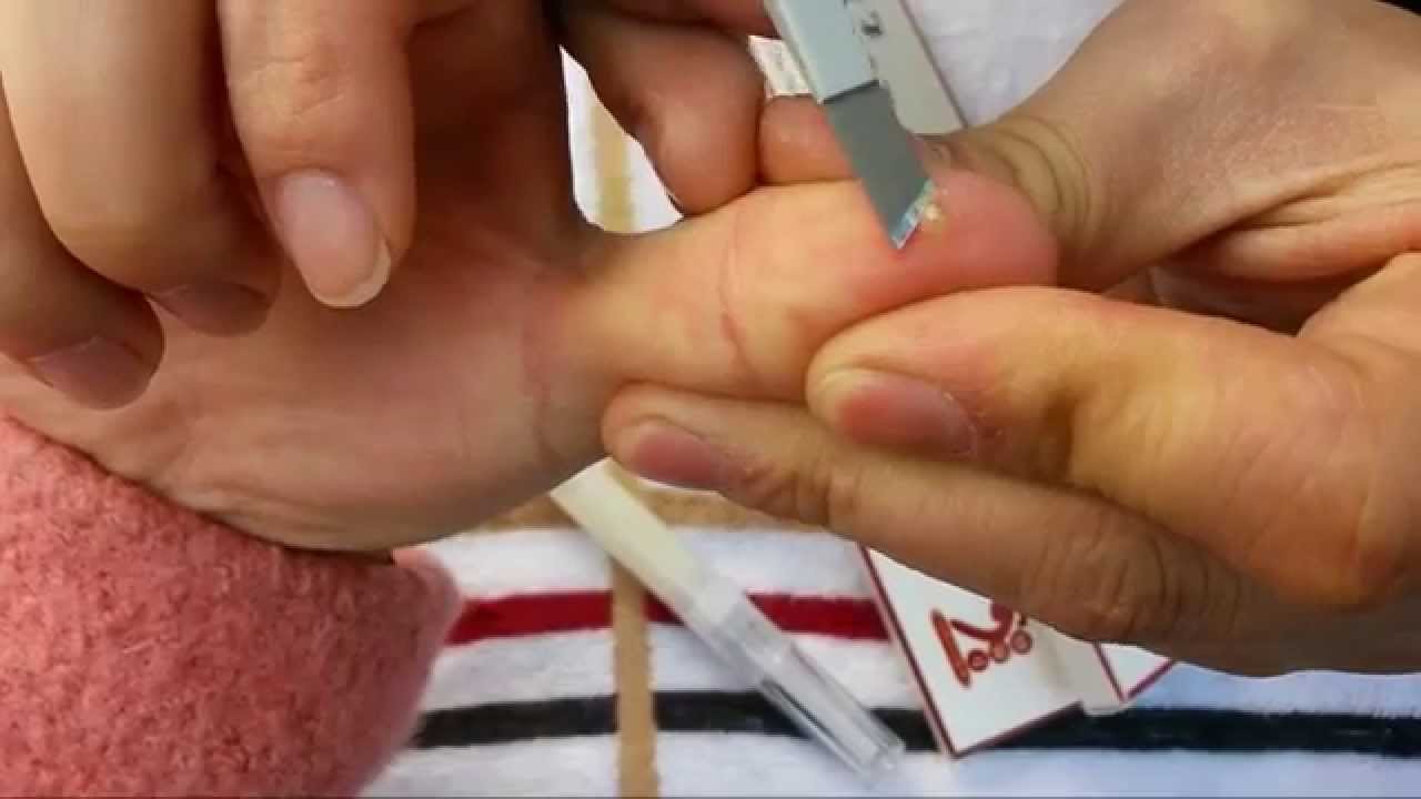 指に出来たウィルス性イボを芯ごと除去 part3 Finger papilloma warts 