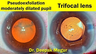 Trifocal Lens In Moderately Dilated Pupil With Pseudoexfoliation - Dr Deepak Megur