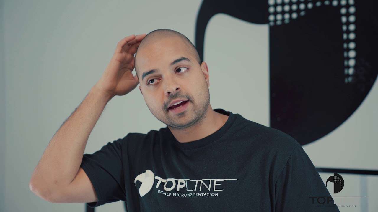 Norwood Scale Explained - Male Pattern Baldness