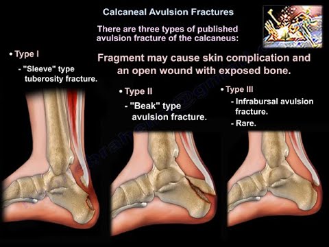 Calcaneal Avulsion Fractures - Everything You Need To Know - Dr. Nabil Ebraheim