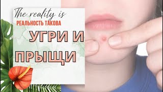Как избавиться от угрей прыщей и акне природным путём 