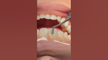 Composite veneer for anterior central tooth 🦷 #dentist
