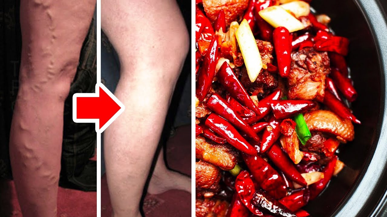 Prevent Varicose Veins By Adding This To Your Diet 