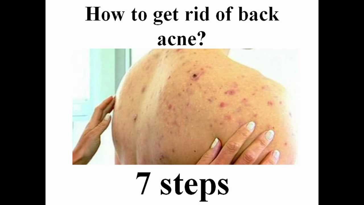 How to Get Rid of Back Acne YouTube