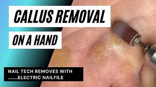 Hard Skin Removal, Callus On An Overworked Palm