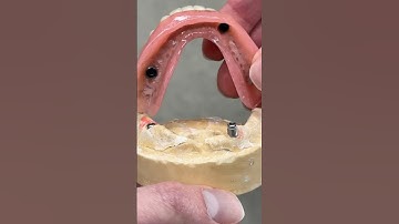 2-Locator Denture #dental #teeth #smile #lsk121shorts #shortvideo #shorts #dentures