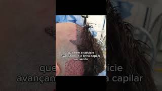 Transplante capilar - Testa Grande