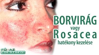 Borvirágos bőr, vagyis a Rosacea és visszér hatékony kezelése - Fő az egészség!(, 2014-12-01T13:53:32.000Z)