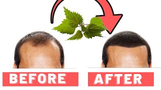 Stinging Nettle Root For Hair Loss: How It Works