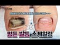 펜싱🤺하면서 항상 멍이 들어오시는 고객님‼️ 멍든 발톱 스케일링🖤 / Fencing-Lover’s Bruised Toenail Scaling