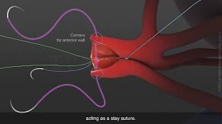 Side-to-side arterioplasty for renal arteries on donor kidney graft