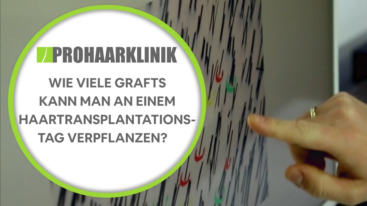 Wie viele Grafts kann man an einem Haartransplantationstag verpflanzen