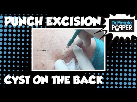 A Nice Little Cyst Punch On The Back