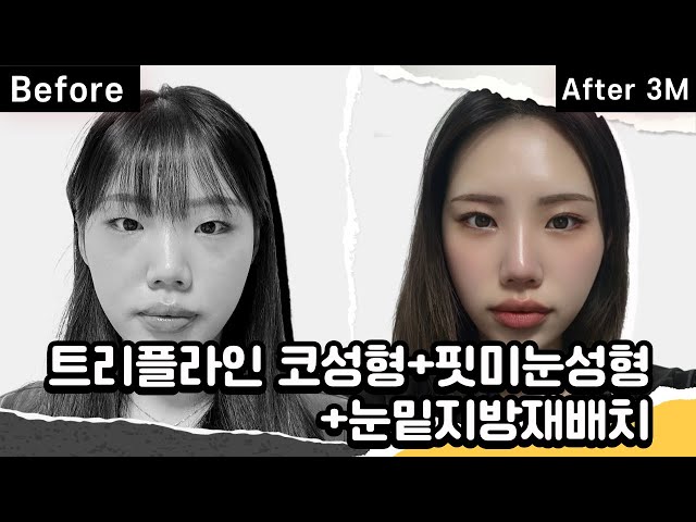자연스럽게 예뻐지는 방법!! 궁금하지 않으세요!?🙄 I 리얼후기 영상 👀 함께보시죠(트리플라인 코성형+핏미눈성형+눈밑지방재배치)