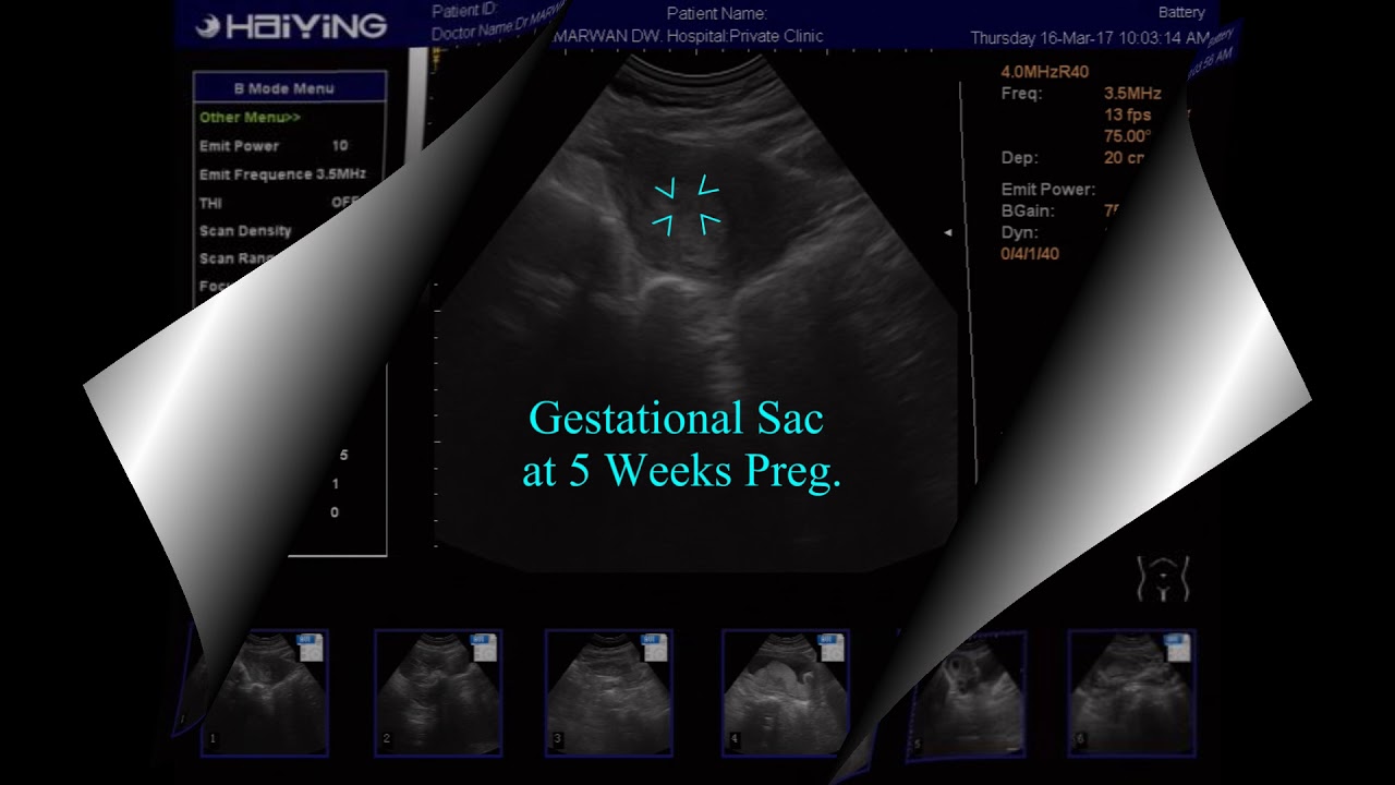 Transabdominal Ultrasound5 Weeks Pregnant Youtube