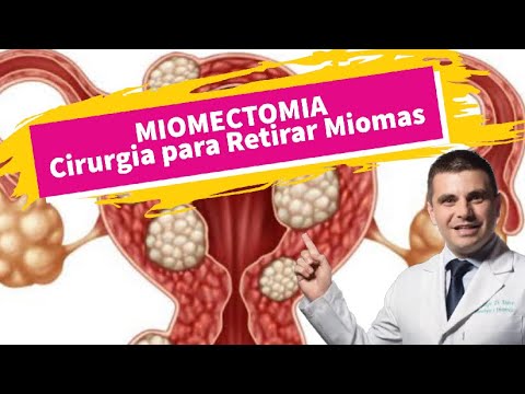 Vídeo: 3 maneiras de remover miomas