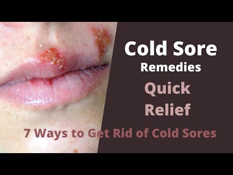 Cold Sore Remedies - 7 Best Ways to Get Rid of Cold Sores