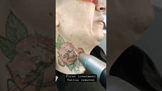 Removing With Picosecond Laser