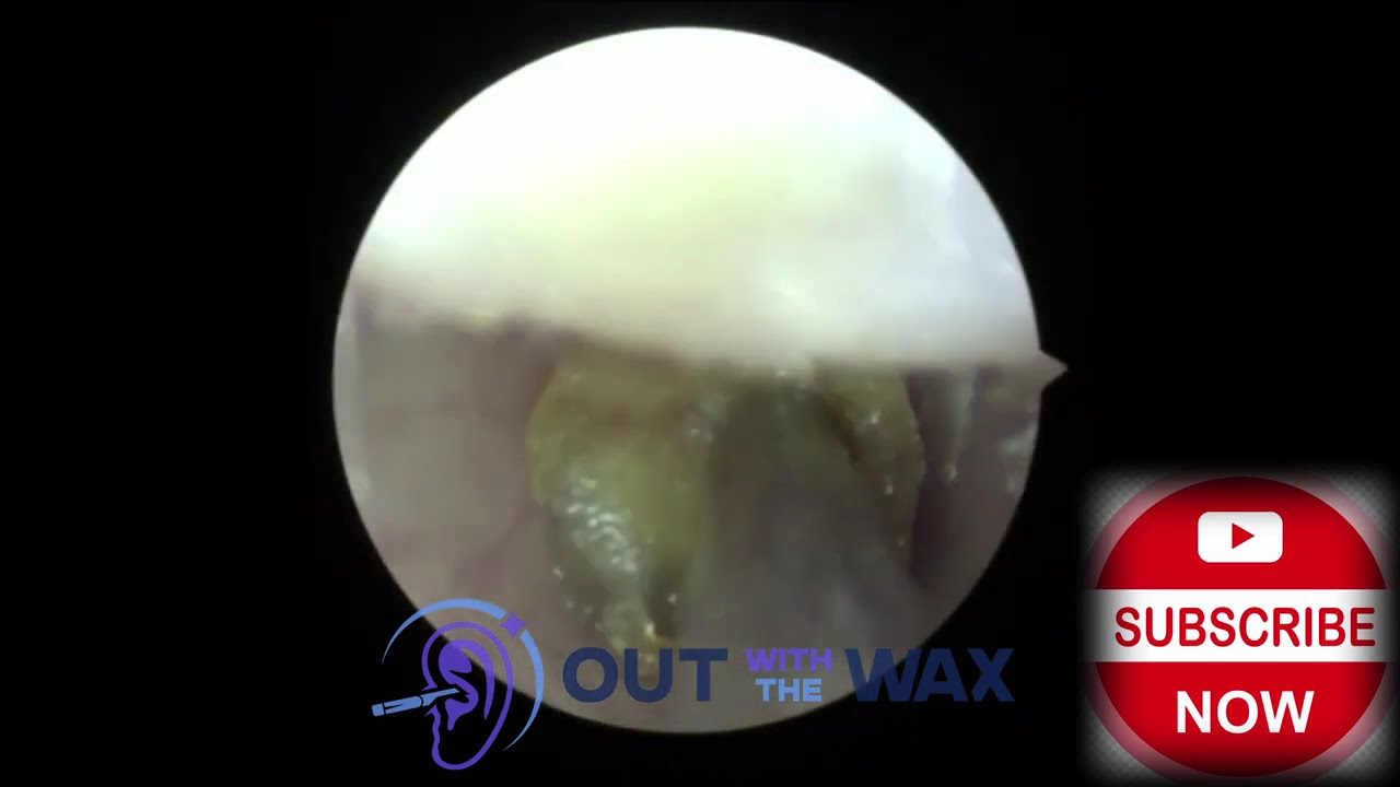 1-Minute Earwax Removal for Hearing Aid Wearer – Quick & Satisfying!