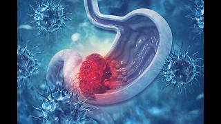 Gastric Cancer: Introduction/Workup/Management