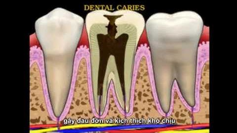 Điều trị răng sâu an toàn hiệu quả