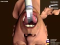 ISim2: An Endotracheal Intubation Simulation