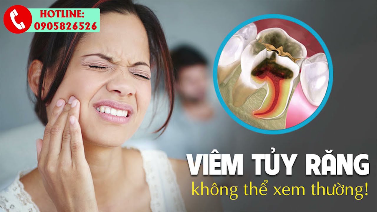 Viêm tuỷ răng và dấu hiệu nhận biết viêm tuỷ răng - YouTube
