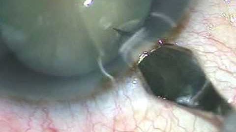 S1 Phaco - main incision and side port