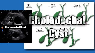 Sonoquickies - Choledochal Cysts