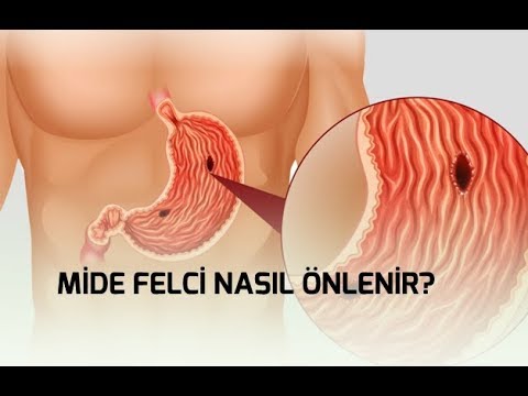 MİDE FELCİ NASIL ÖNLENİR?